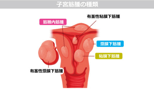 子宮筋腫の種類図解