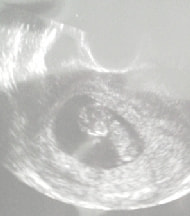 妊娠10週の胎児（超音波写真）