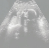 妊娠22週の胎児（超音波写真）