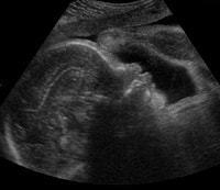 妊娠32週の胎児（超音波写真）