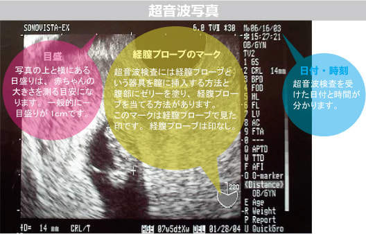 超音波写真の見方図解