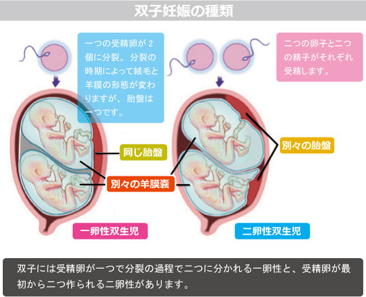 双子妊娠の種類（胎児）図解