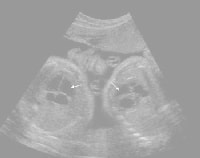双子妊娠超音波（エコー）