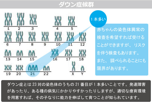 染色体異常(ダウン症)図解