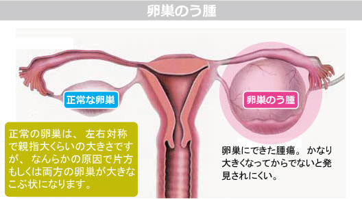 卵巣のう腫図解