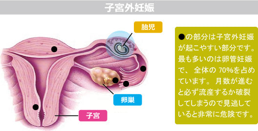 子宮外妊娠図解