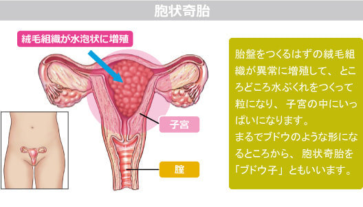 胞状奇胎図解
