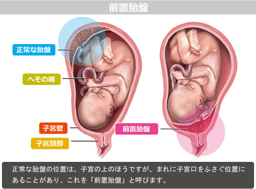 前置胎盤図解