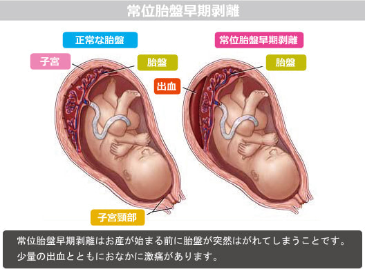 常位胎盤早期剥離図解