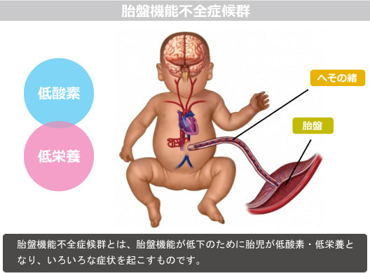 胎盤機能不全症候群図解