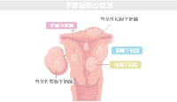子宮筋腫も早産の原因に