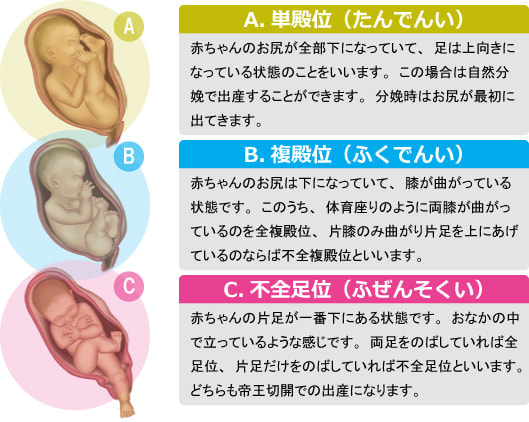 逆子の種類図解