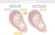 常位胎盤早期剥離図解