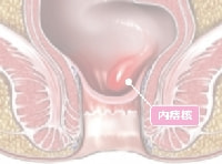 内痔核図解