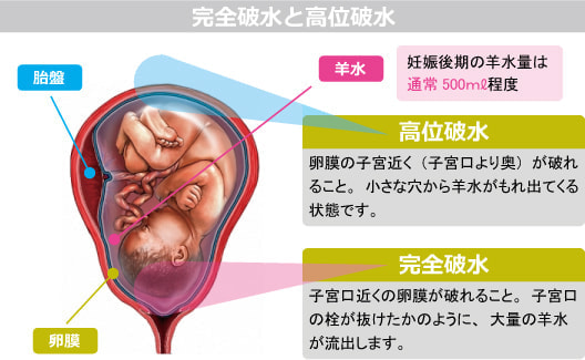 完全破水と高位破水の図解