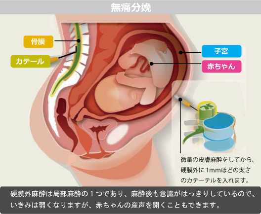 無痛分娩・図解