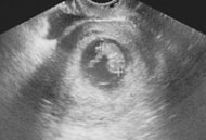 妊娠8週の胎児（超音波写真）