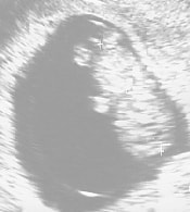 妊娠9週の胎児（超音波写真）
