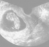 妊娠11週の胎児（超音波写真）