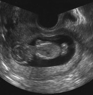 妊娠12週の胎児（超音波写真）