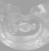 妊娠12週の胎児（超音波写真）