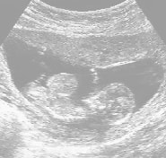 妊娠13週の胎児（超音波写真）