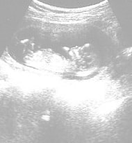 妊娠14週の胎児（超音波写真）