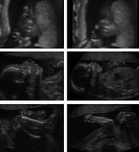 妊娠15週の胎児（超音波写真）