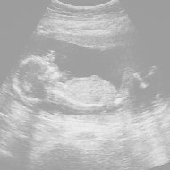 妊娠16週の胎児（超音波写真）