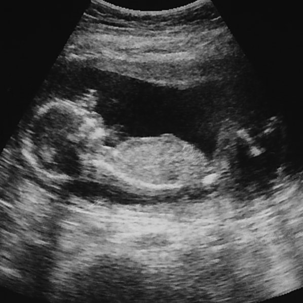妊娠16週 赤ちゃん 症状