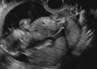 妊娠17週の胎児（超音波写真）