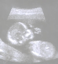 妊娠18週の胎児（超音波写真）