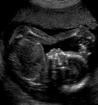 妊娠19週の胎児（超音波写真）