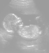 妊娠20週の胎児（超音波写真）