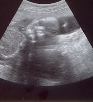 妊娠21週の胎児（超音波写真）