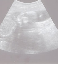 妊娠21週の胎児（超音波写真）
