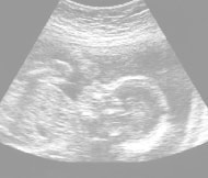 妊娠23週の胎児（超音波写真）