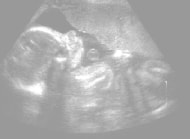 妊娠24週の胎児（超音波写真）