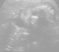 妊娠25週の胎児（超音波写真）