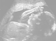 妊娠26週の胎児（超音波写真）